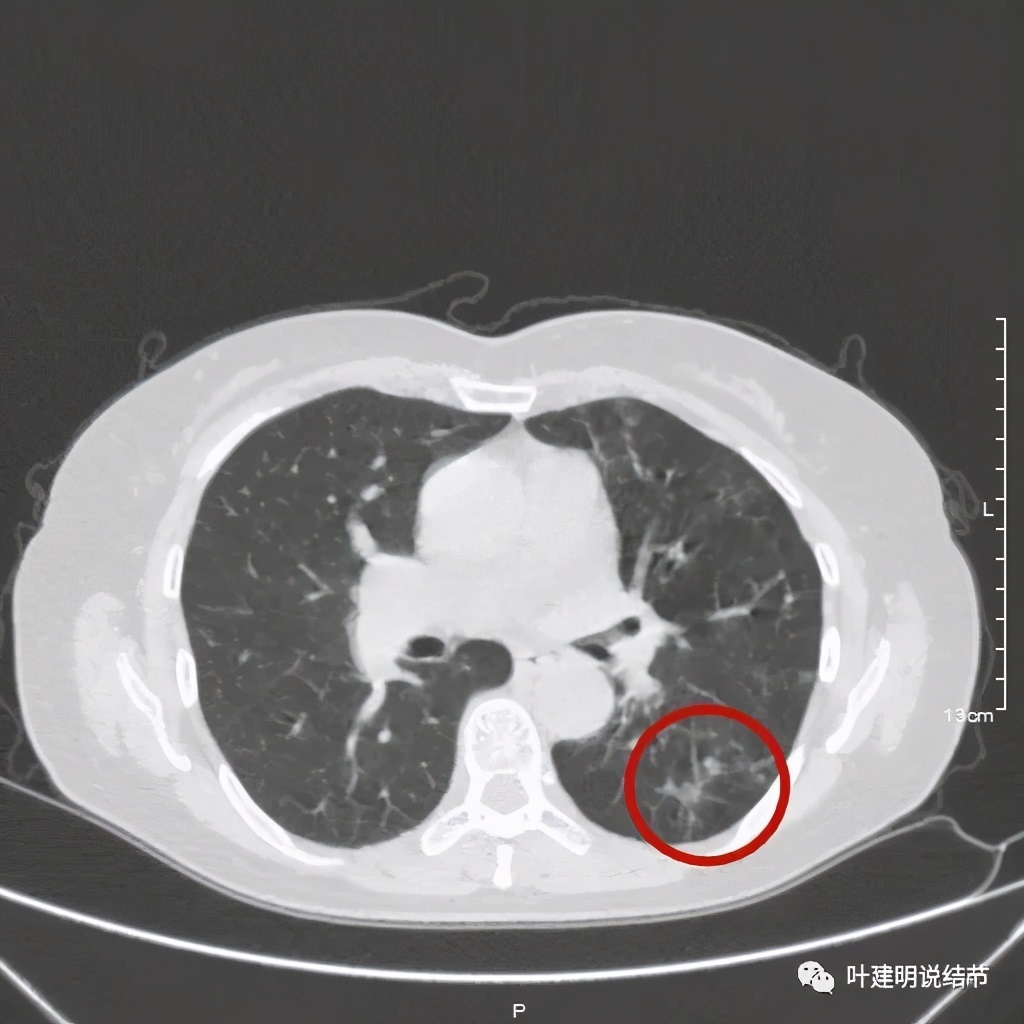 这样的实性结节伴小空洞会是肺癌吗？