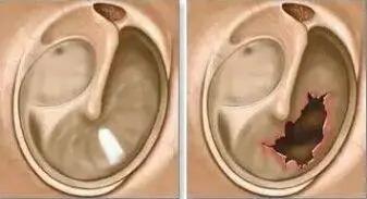 小孩半夜耳朵疼怎么解决,急性中耳炎耳朵痛