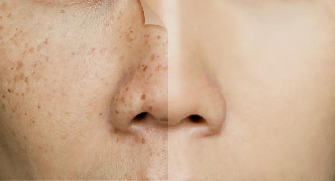 不做黄脸婆告别色斑,不做黄脸婆该怎么做