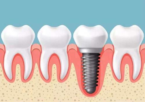 烤瓷牙和种植牙哪个副作用大,烤瓷牙和种植牙比较优缺点有哪些