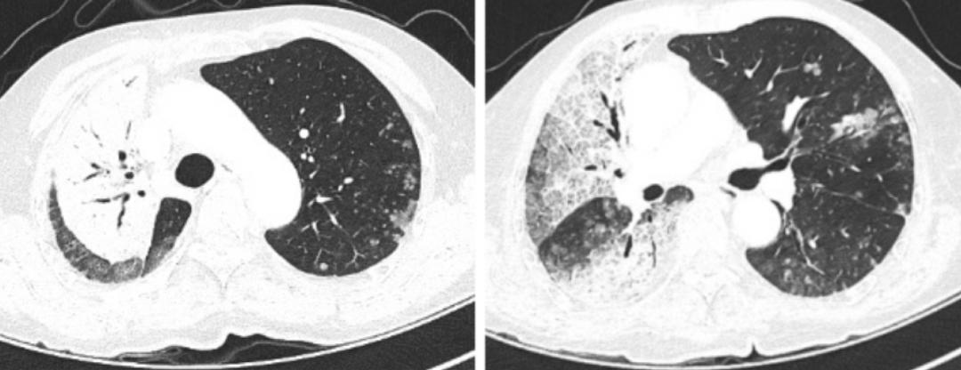 时隔一年再次住院,时隔一年旧病复发