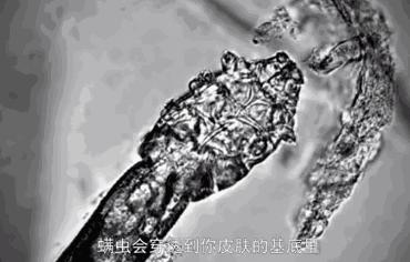 爱长痘的人一直长痘,爱长痘痘的皮肤