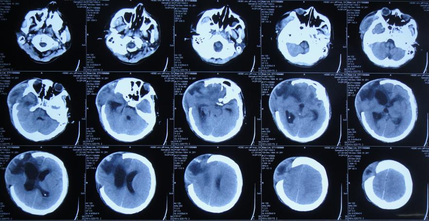 开颅手术后颅内细菌感染图片,外伤开颅手术后脑积液能恢复吗