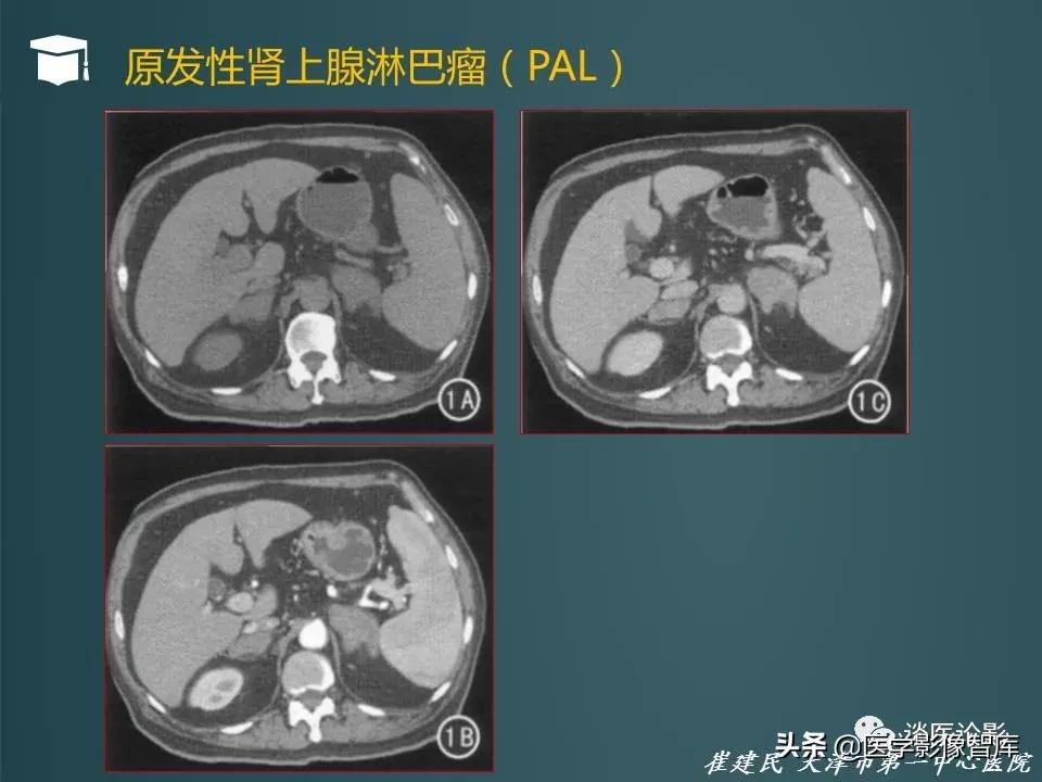 左侧肾上腺结节考虑腺瘤与增生,双侧肾上腺增生是什么原因造成的