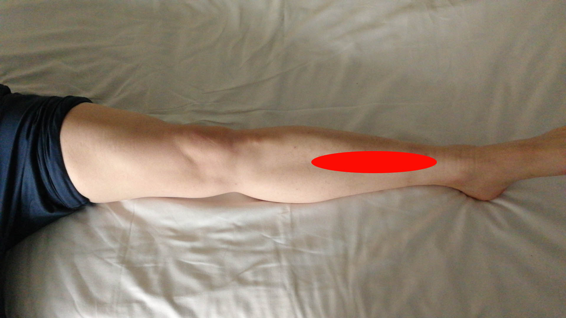 跑完步后小腿迎面骨按压痛,小腿前侧迎面骨疼