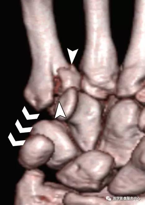 手腕撕脱性骨折一年了还隐隐作痛,手腕三角骨撕脱骨折症状有哪些