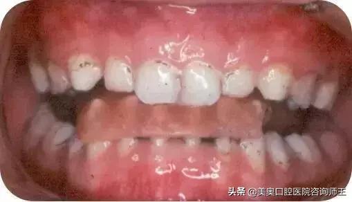 牙齿矫正地包天多久能看到效果,地包天越早矫正越好吗