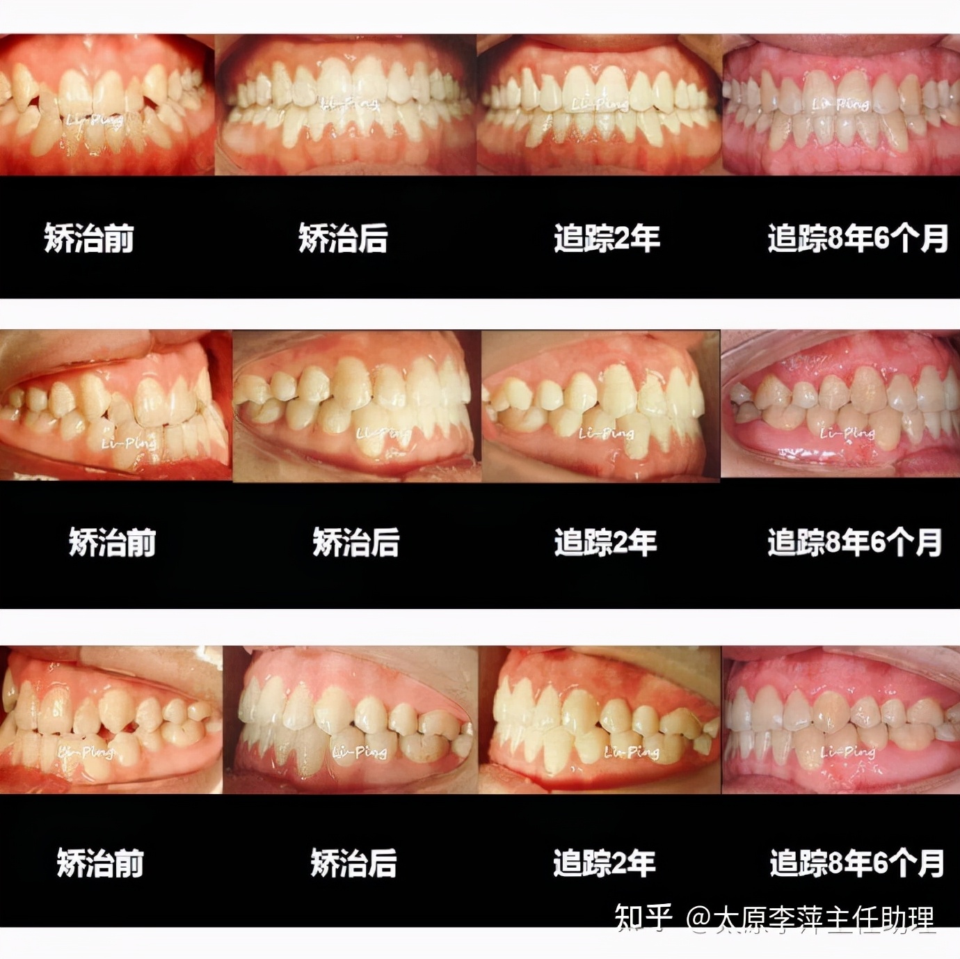 太原市牙齿正畸,太原市口腔正畸