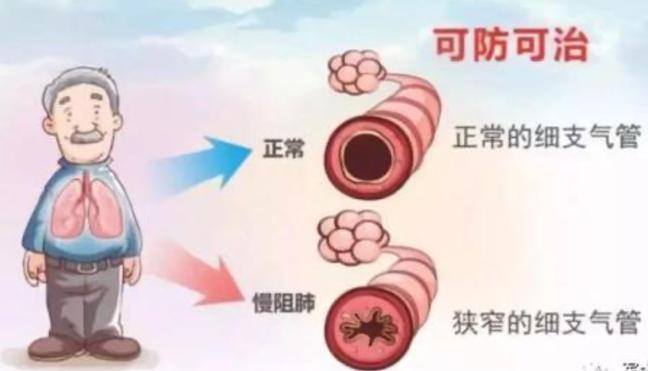 慢阻肺与肺心病有关吗,慢阻肺跟轻度呼吸障碍