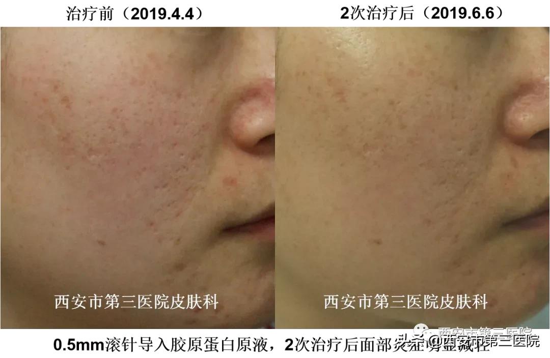 紧致肌肤的微针,淡化细纹微针