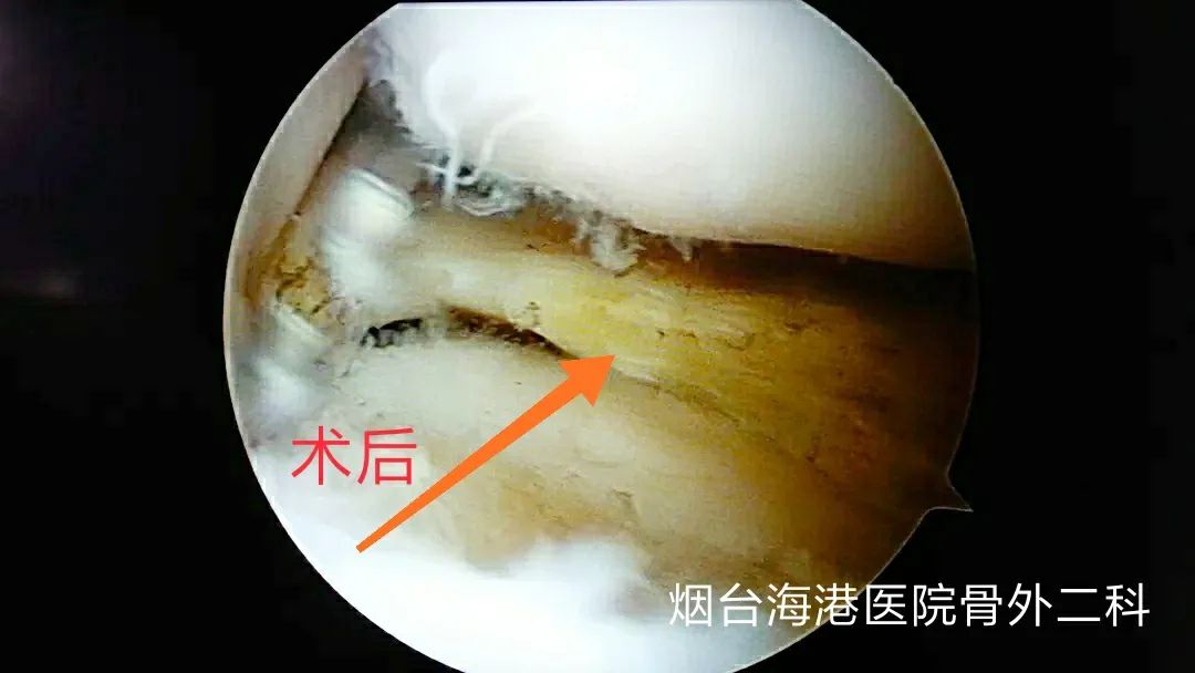 膝关节半月板损伤2-3度手术,半月板关节镜微创手术恢复状况