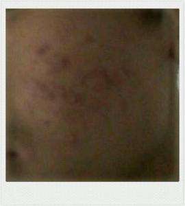 脸上有坑坑洼洼的痘印怎么消除,脸上坑坑洼洼女生