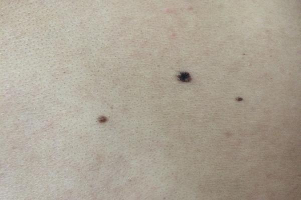 身上出现这几种痣要注意了,身上这两类痣可能是大病信号