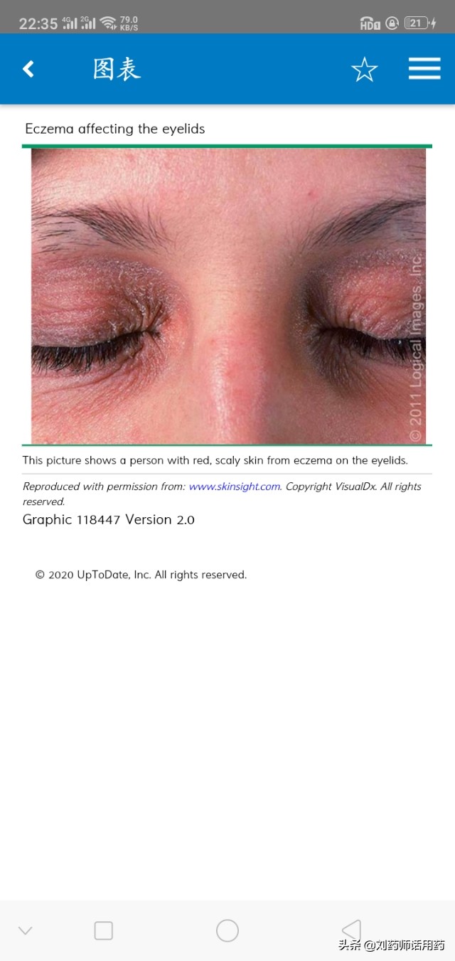 如何缓解湿疹瘙痒症状,外阴瘙痒湿疹症状