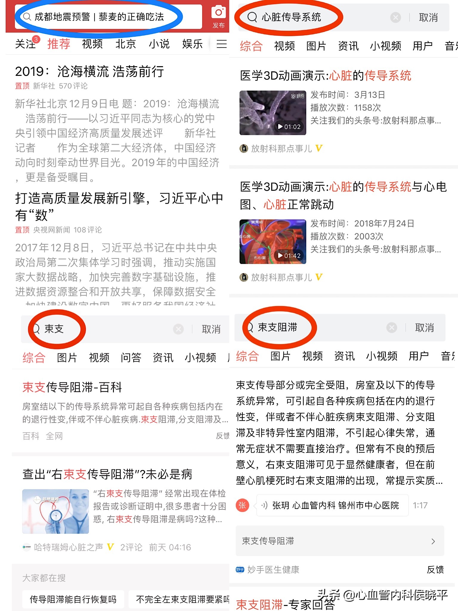 左束支阻滞、右束支阻滞、…,心脏里的“束支”是怎么回事?