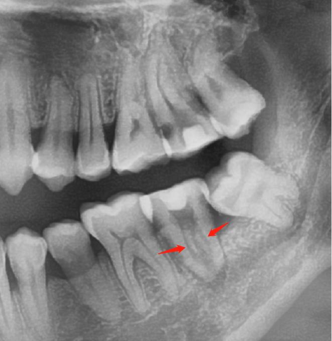 你们做根管治疗花了多少钱,根管治疗做了真的有用吗