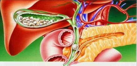 小的结石有什么办法可以排出,胆囊结石掉到胆总管必须手术吗