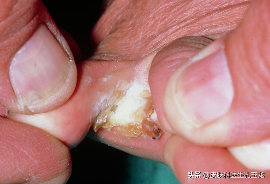 医院皮肤科医生治脚气用什么药,皮肤科医生脚气脚臭怎么办