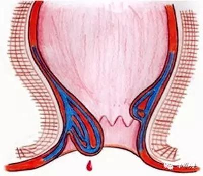 男性肛周潮湿是啥病,外痔引起的肛周潮湿