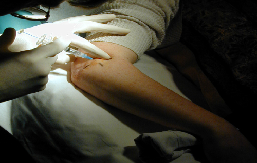 网球肘有好的治疗方法吗,网球肘有哪些治疗方法