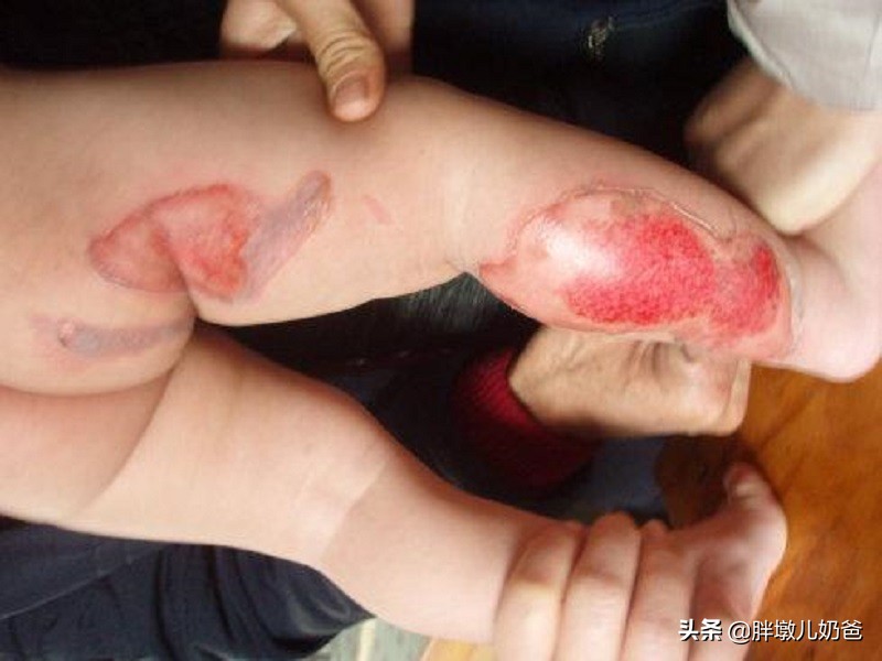 小腿烫伤结痂了还需用纱布包扎吗,小腿被开水烫伤起泡了该怎么处理