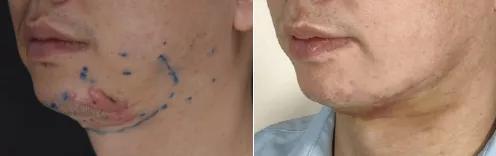 打耳洞耳朵增生,只要打耳洞就会耳洞增生