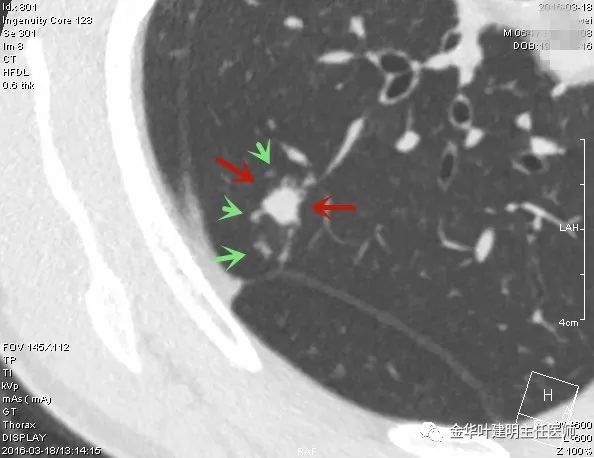 叶建明谈胸膜下的实性结节,叶建明肺实性良性结节会变癌症吗