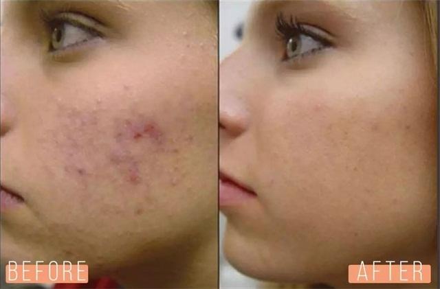 痘印严重到底怎么办,毁容式痘痘有什么办法消除