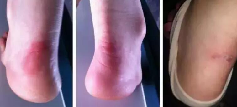 鞋子磨脚处理的简单方法图片,透明拖鞋脚底板磨脚怎么办