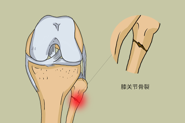 关节损伤注意事项有哪些,关节损伤最佳处理方法