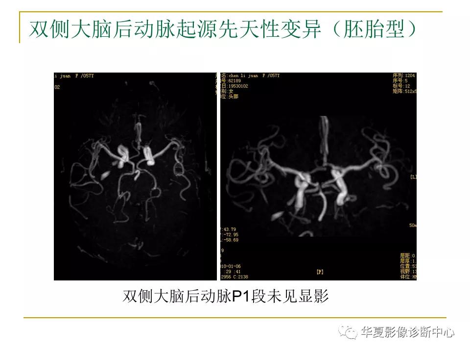 中国人脑立体定向mri应用解剖图谱,脑mri示意图