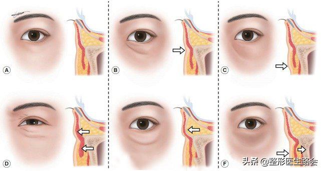如何区分结构性泪沟,泪沟太明显怎么自己改善