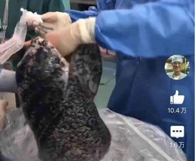 长期吸烟的人戒烟后肺部变化,长期抽烟戒烟后会有什么变化