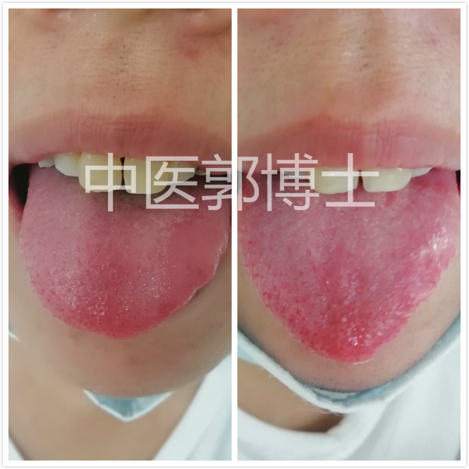 喜睡前加餐，脾肿大，血小板增多，但无不适感，服药后剥脱苔改善