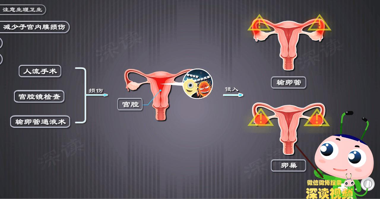 附件炎怎么造成的,人流后附件炎