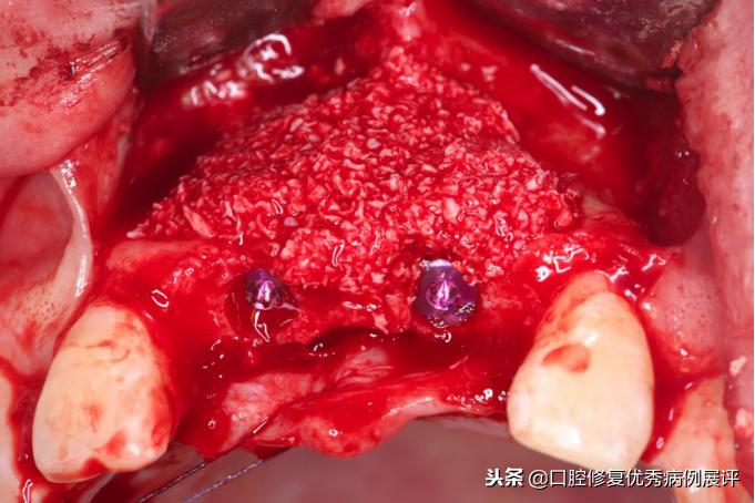 展评优秀病例赏析|Asc全瓷角度基台一体冠进行种植前牙美学修复