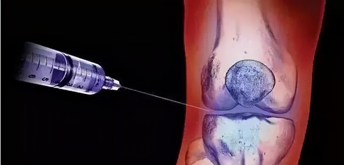 膝关节炎打玻璃酸钠几针见效,膝关节炎打玻璃酸钠有效吗