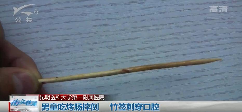 一根烤肠险些要了这个宝宝的命！8厘米竹签从口腔刺破咽喉，尖端险些刺入生命中枢