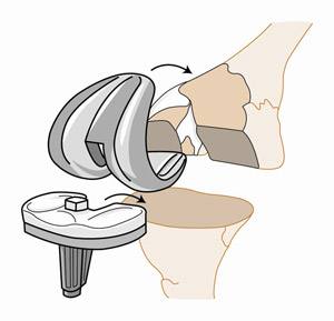 痛风膝关节红肿疼痛如何快速消除,膝关节痛风性关节炎mri表现