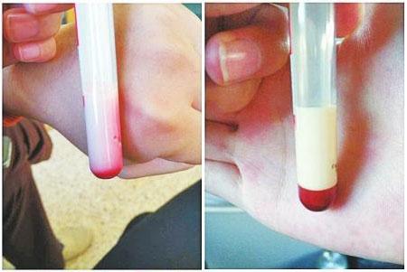 孕妇抽血抽出绿色血,夫妻孕期检查抽血