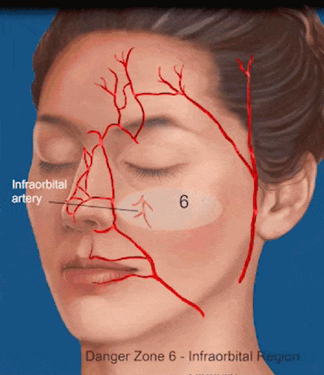 提眉过程中会不会川字纹加重,提眉术可以改善川字纹吗