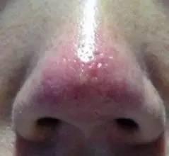 泰国去黑头的正确方法,大米去黑头的正确方法