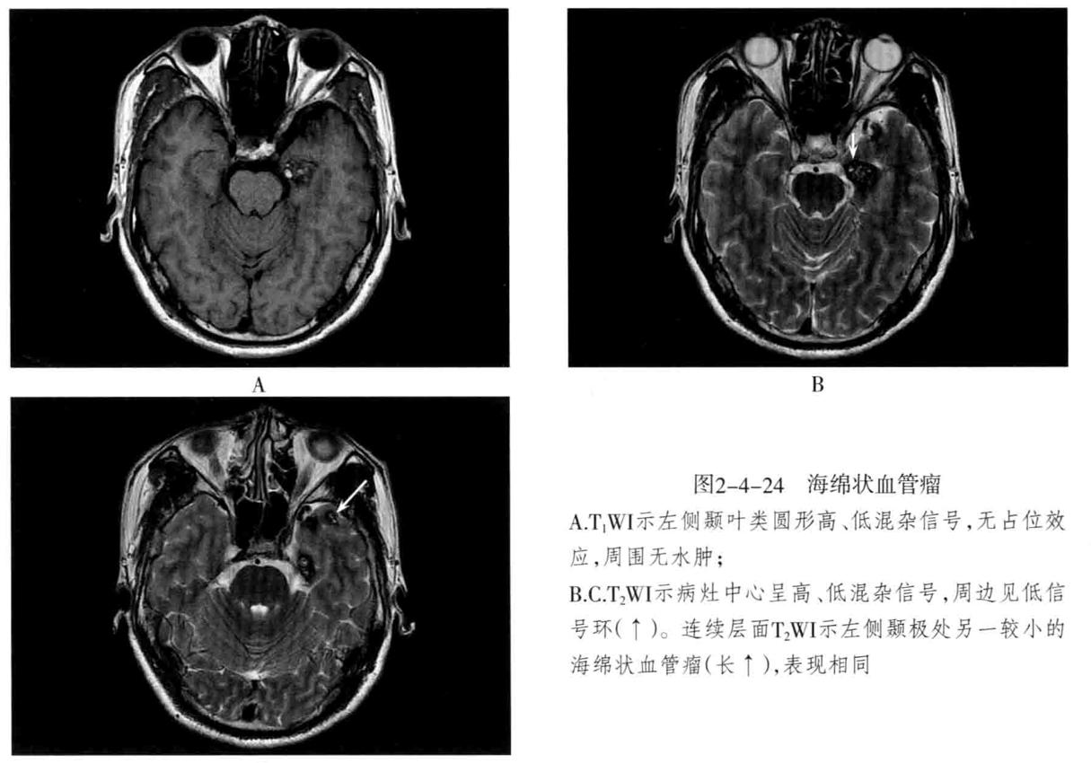 颅内血管周围间隙的影像鉴别,颅脑血管源性疾病影像诊断