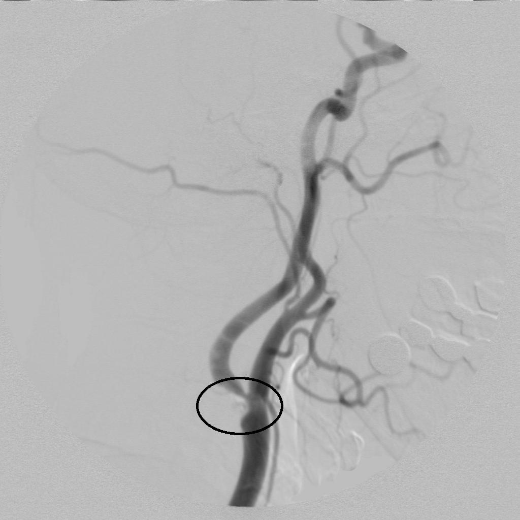 脑中风治疗一般几个疗程,一分钟识别脑卒中正确的做法