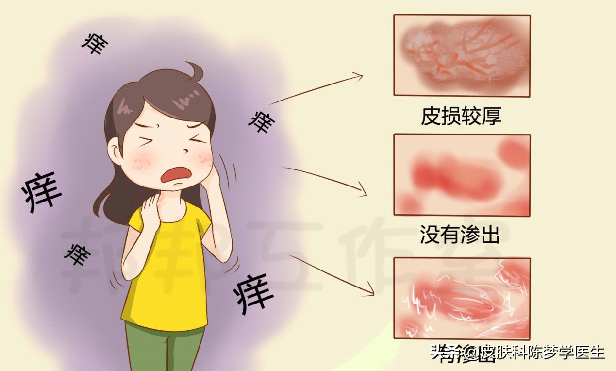 湿疹痒疹同时生长怎么治疗,湿疹全身痒怎么办不用激素