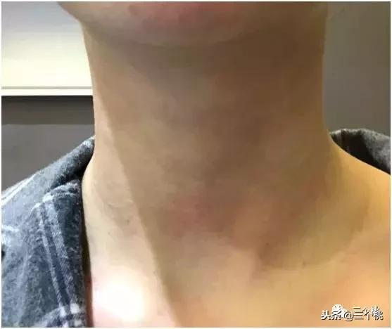 医美去颈纹全过程,去颈纹医美过程