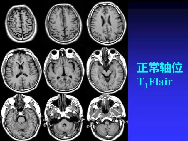 头颅mri读片视频教程,颅脑mri读片入门教程视频讲解全集