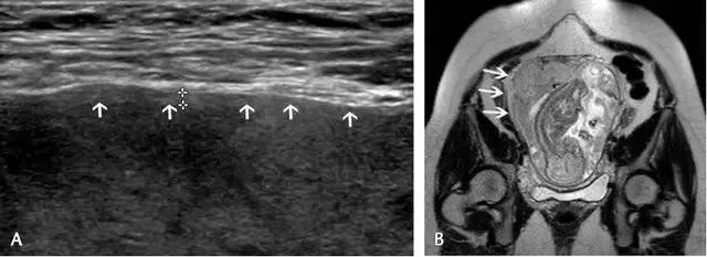 临床上最常见的异常胎盘,前置胎盘和低置胎盘超声