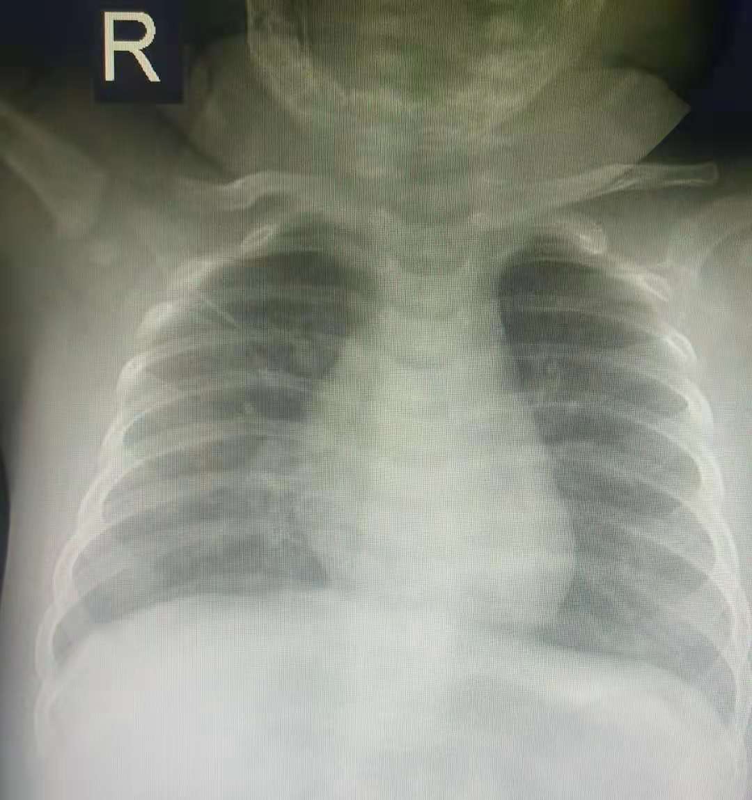 社区获得性肺炎病例讨论ppt,社区获得性肺炎的病情观察