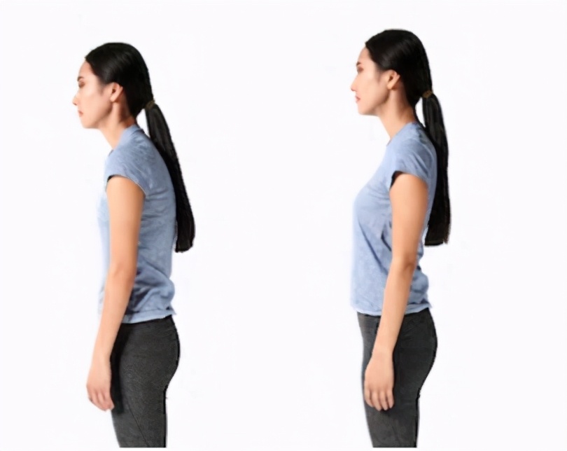 驼背是用什么查的,驼背有什么样子